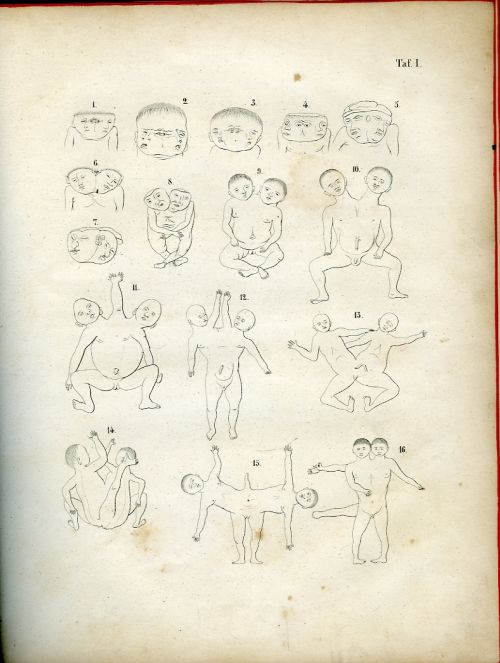 [Die Missbildungen des Menschen systematisch dargestellt.] Atlas.